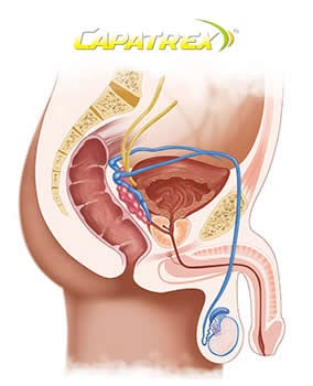 Capatrex prostata